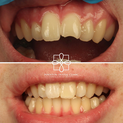 before and after dental treatment showing improved smile with seven teeth visible in each photo